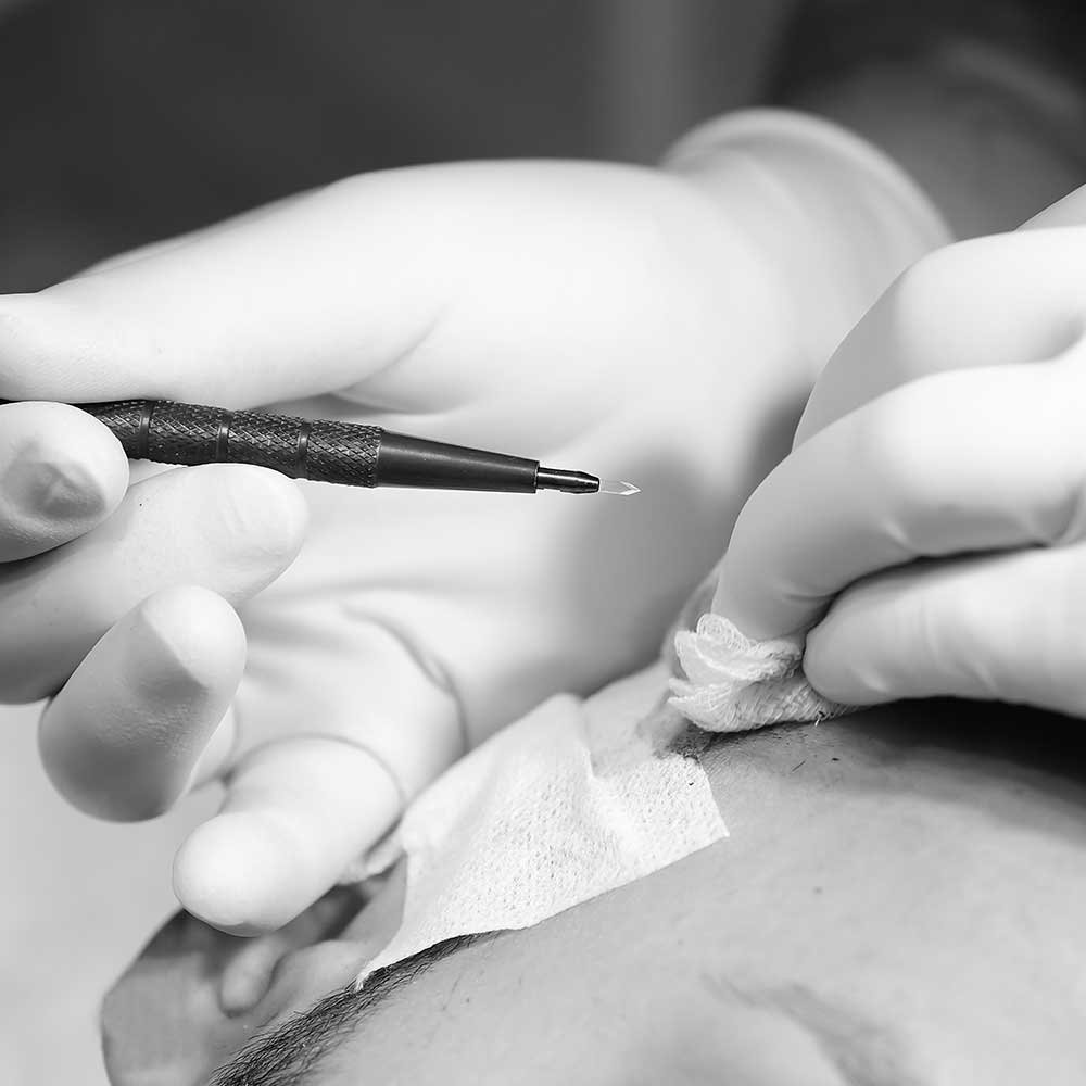 Greffe de cheveux FUE à Thionville